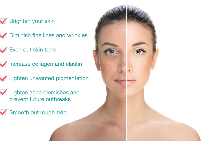 aha chemical peel