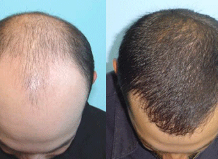Platelet Rich Plasma (PRP) - Dermesthetic Clinic Platelet Rich Plasma (PRP) - Dermesthetic Clinic