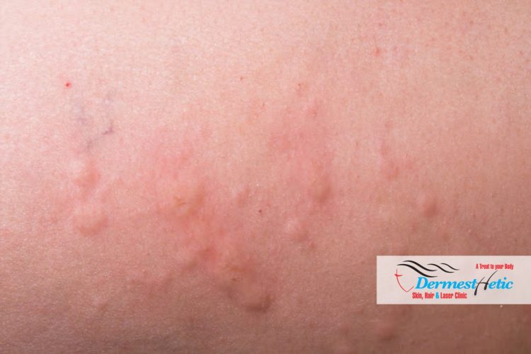 Hidradenitis Suppurativa Treatment Dermesthetic Clinic