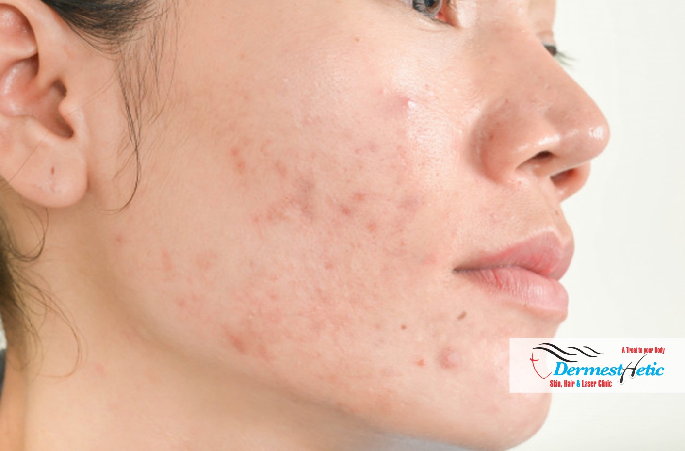 Hidradenitis Suppurativa Treatment Dermesthetic Clinic